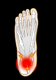 足の裏（足底）の痛みの原因とふくらはぎの関連性