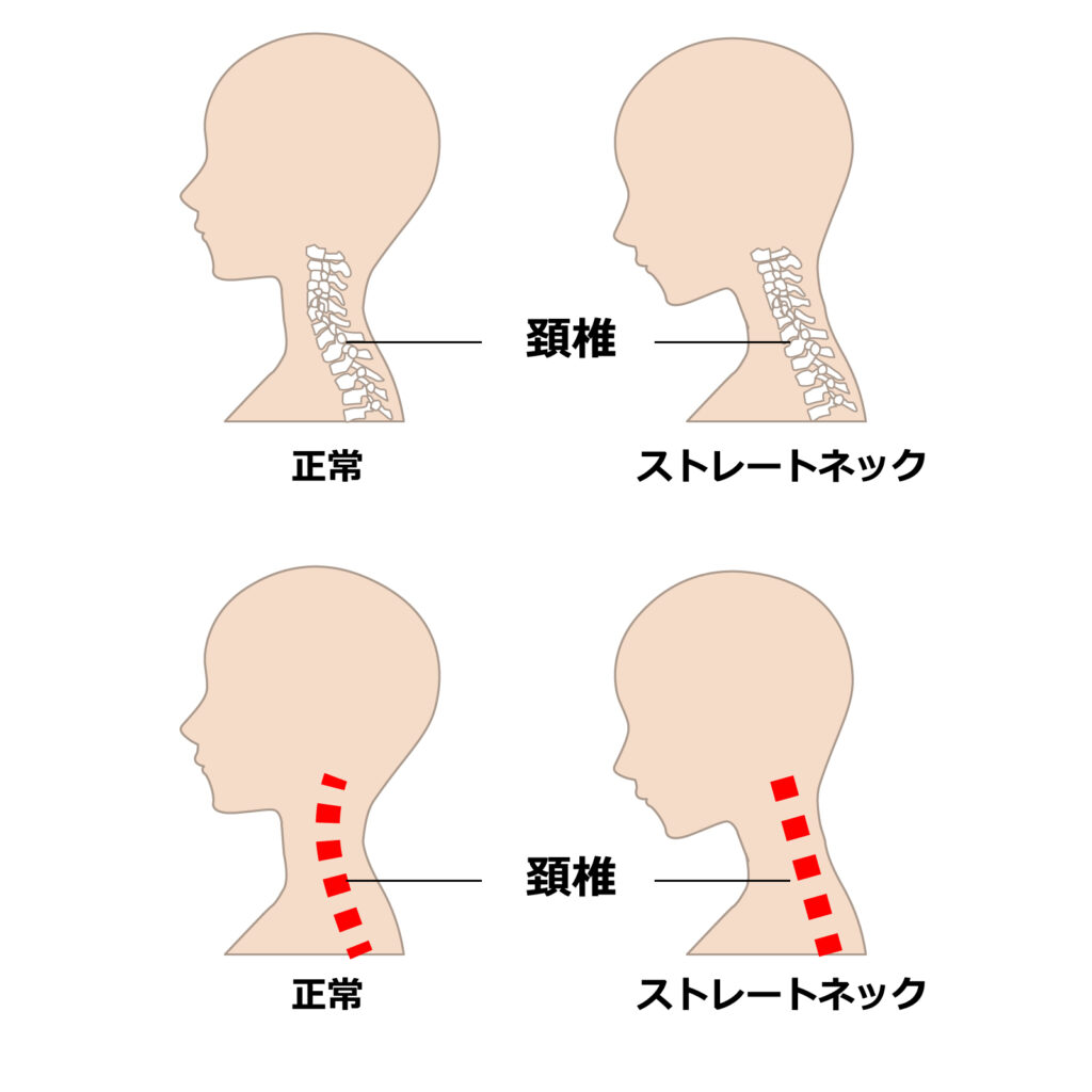 ストレートネック（スマホ首）について