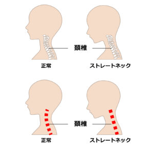 スマホの見過ぎによる肩こり・頭痛・スマホ首の原因と改善策
