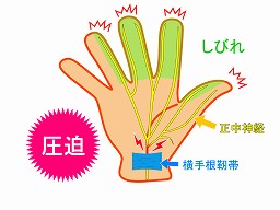 手根管症候群（手の痺れ）