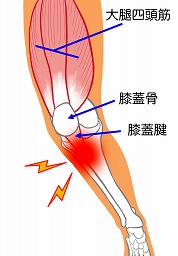 膝を曲げると足の後ろ側が痛い