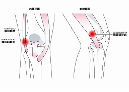 膝の外側の痛み
