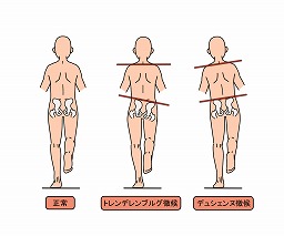 氷上を歩いているような感覚がある（歩行時）