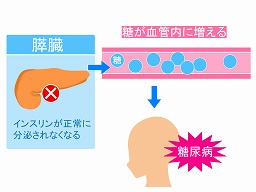 糖尿病での運動療法について