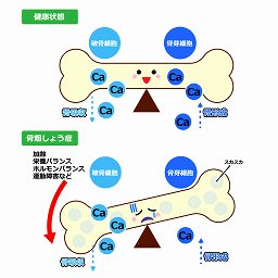 骨折しやすくなる骨粗しょう症