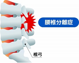 腰痛の原因となる腰椎分離症とは