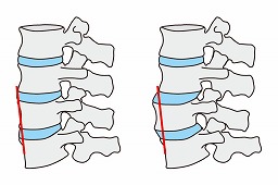 腰痛の原因となる腰椎分離症とは